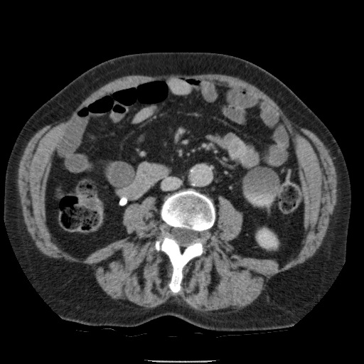 Bladder tumor detected on trauma CT (Radiopaedia 51809-57609 C 73).jpg