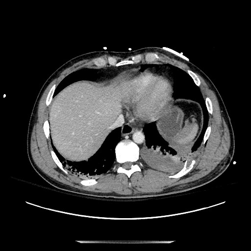 Blunt abdominal trauma with solid organ and musculoskelatal injury with active extravasation (Radiopaedia 68364-77895 A 13).jpg
