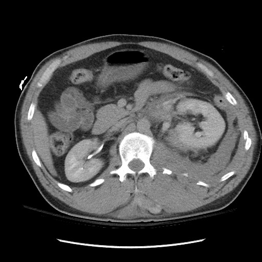 Blunt abdominal trauma with solid organ and musculoskelatal injury with active extravasation (Radiopaedia 68364-77895 Axial C+ delayed 55).jpg