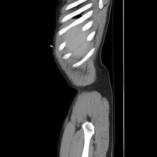 File:Blunt abdominal trauma with solid organ and musculoskelatal injury with active extravasation (Radiopaedia 68364-77895 C 23).jpg