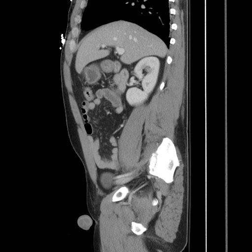File:Blunt abdominal trauma with solid organ and musculoskelatal injury with active extravasation (Radiopaedia 68364-77895 C 57).jpg