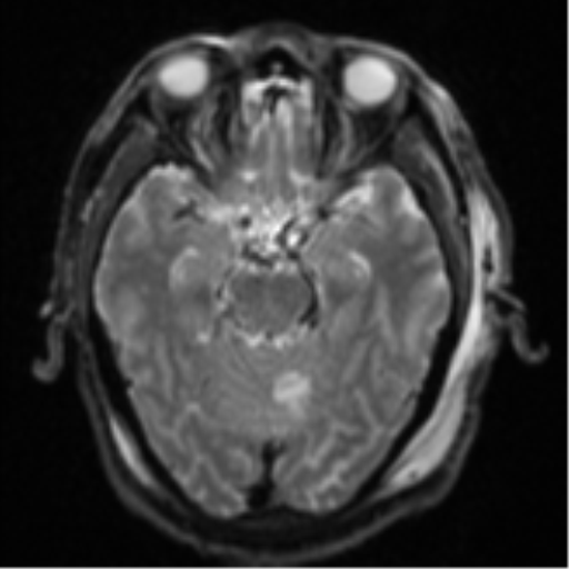 Blunt cerebrovascular injury (Radiopaedia 53682-59745 Axial DWI 12).png