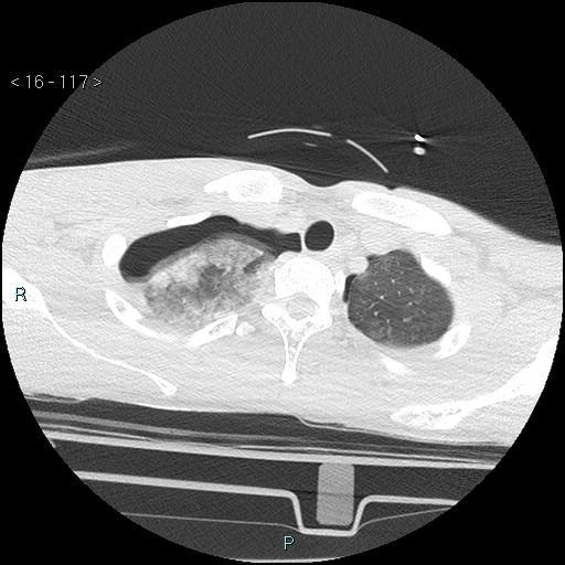 Blunt chest trauma (Swiss cheese sign) (Radiopaedia 38519-40618 Axial lung window 6).jpg