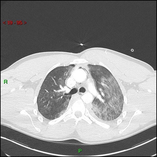 Blunt thoracic trauma (Radiopaedia 73454-84221 Axial lung window 34).jpg