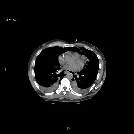 Boerhaave syndrome (Radiopaedia 27683-27897 Axial non-contrast 56).jpg