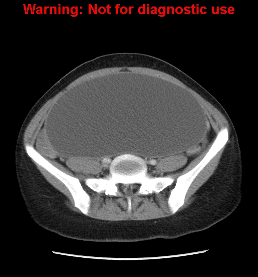 Borderline mucinous cystadenoma of ovary (Radiopaedia 25586-25767 A 66).jpg