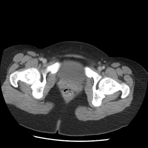 File:Borderline mucinous tumor (ovary) (Radiopaedia 78228-90808 A 137).jpg