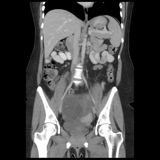 Borderline mucinous tumor (ovary) (Radiopaedia 78228-90808 C 29).jpg