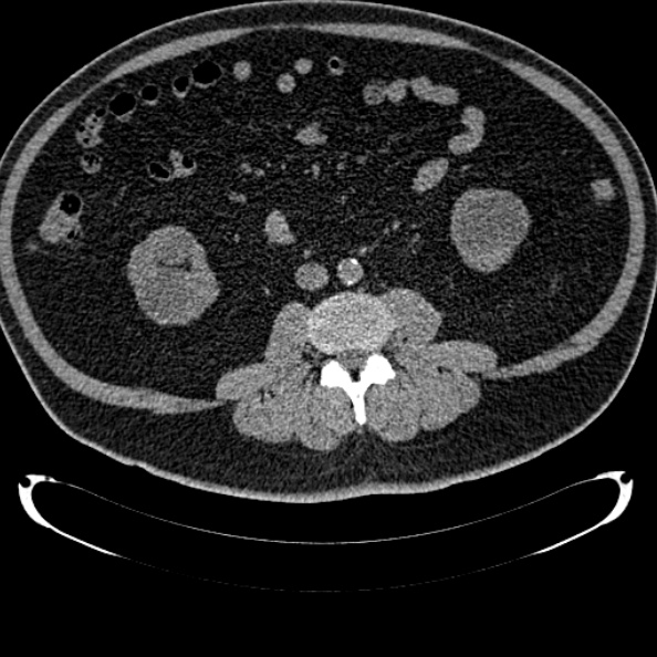 Bosniak renal cyst - type IV (Radiopaedia 24244-24518 Axial non-contrast 177).jpg