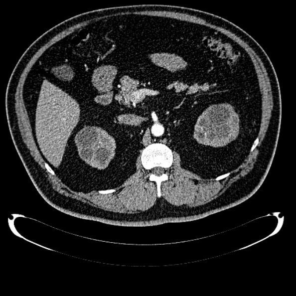 File:Bosniak renal cyst - type IV (Radiopaedia 24244-24518 B 118).jpg