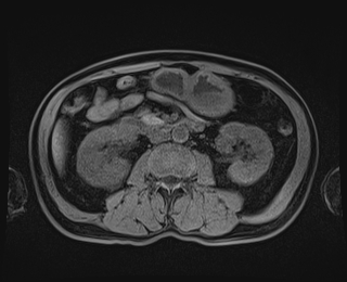 Bouveret syndrome (Radiopaedia 61017-68856 Axial T1 fat sat 47).jpg