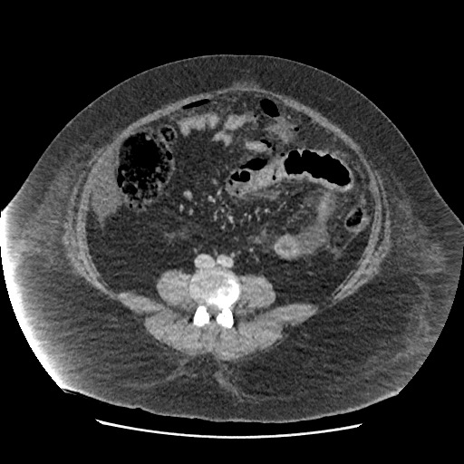 File:Bowel and splenic infarcts in acute lymphocytic leukemia (Radiopaedia 61055-68915 A 82).jpg