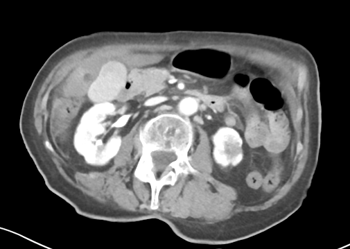 File:Bowel ischemia (Radiopaedia 58273-65382 A 25).png