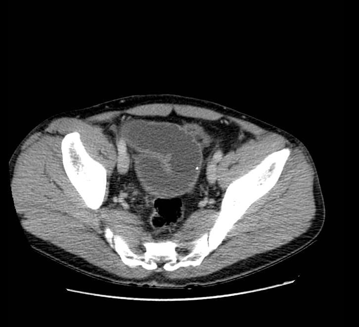 Bowel obstruction from colon carcinoma (Radiopaedia 22995-23028 A 73).jpg