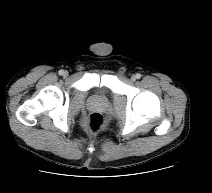 Bowel obstruction from colon carcinoma (Radiopaedia 22995-23028 A 85).jpg