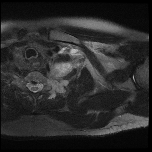 File:Brachial plexus neurofibroma (Radiopaedia 28030-28291 Axial T2 fat sat 10).png