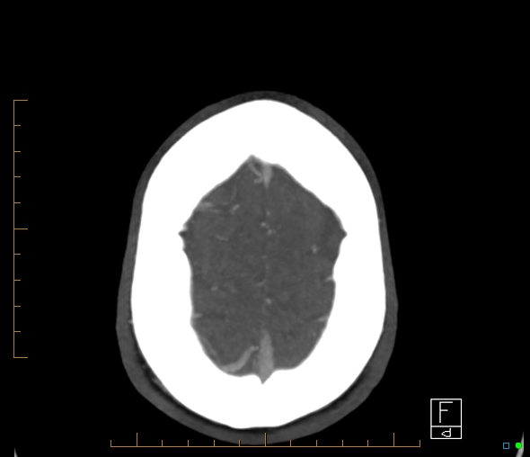 Brachiocephalic trunk stenosis (Radiopaedia 87242-103519 A 6).jpg