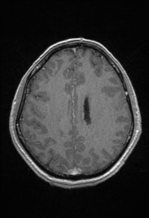 Brain abscess with ventriculitis (Radiopaedia 85703-101495 Axial T1 C+ 122).jpg