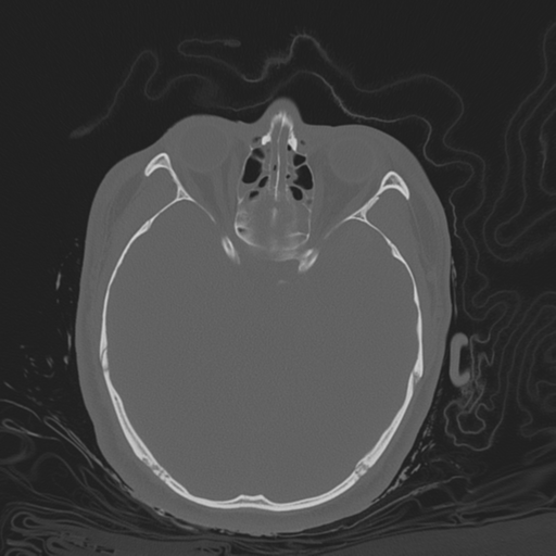 Brain contusions, internal carotid artery dissection and base of skull fracture (Radiopaedia 34089-35339 Axial bone window 66).png