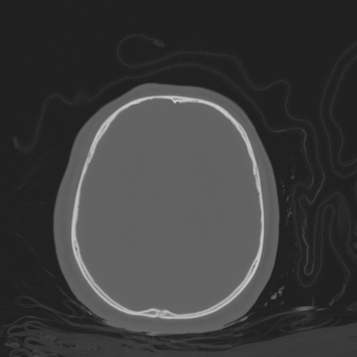 File:Brain contusions, internal carotid artery dissection and base of skull fracture (Radiopaedia 34089-35339 Axial bone window 91).png