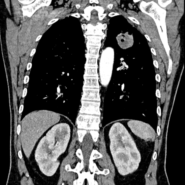 Brain metastases - lung cancer primary (Radiopaedia 75060-86116 C+ arterial phase 49).jpg