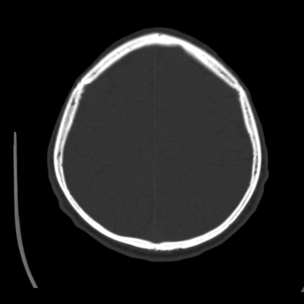 Brain metastases from lung cancer (Radiopaedia 24480-24781 Axial bone window 38).jpg
