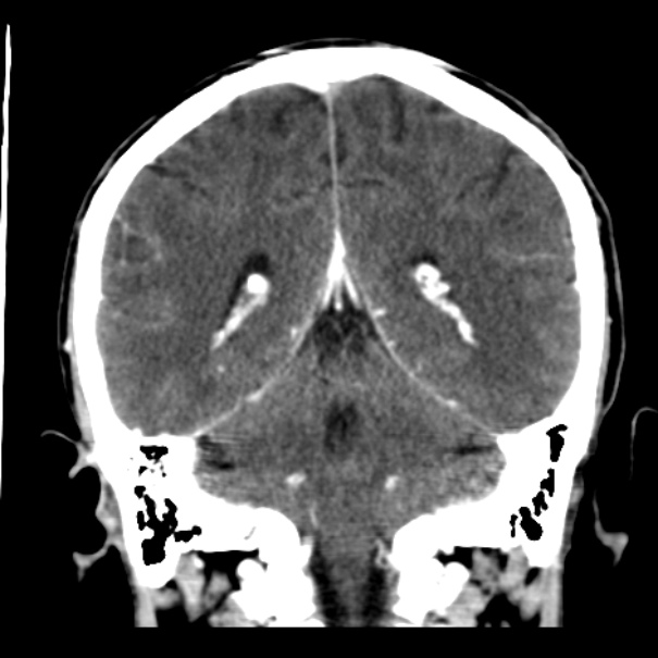 Brain metastases from lung cancer (Radiopaedia 24480-24781 Coronal C+ delayed 42).jpg