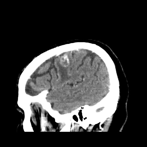 Brain metastasis (Radiopaedia 42617-45760 D 48).jpg
