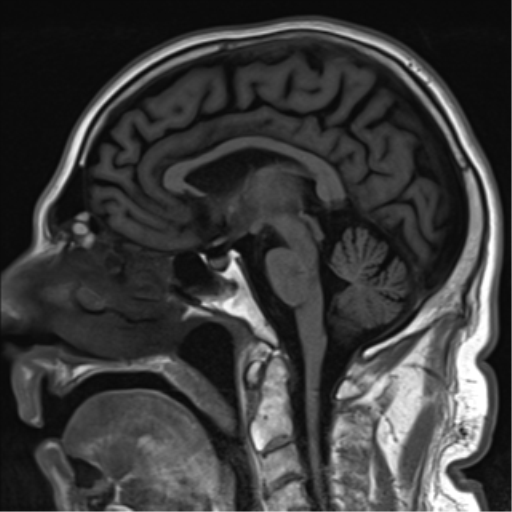 File:Brain metastasis (large cystic mass) (Radiopaedia 47497-52107 Sagittal T1 15).png