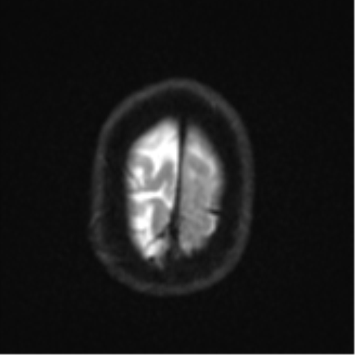 Brain metastasis (lung cancer) (Radiopaedia 48289-53179 Axial DWI 26).png