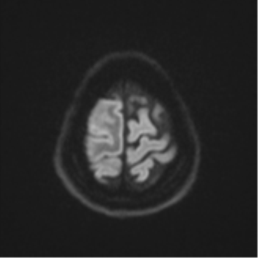 File:Brain metastasis (sarcoma) (Radiopaedia 47576-52209 Axial DWI 52).png
