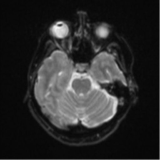 Brain metastasis (sarcoma) (Radiopaedia 47576-52209 Axial DWI 9).png