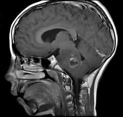 File:Brainstem glioma (Radiopaedia 9444-10124 Sagittal T1 C+ 1).jpg