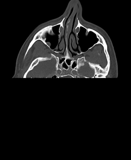 Branchial cleft cyst (Radiopaedia 31167-31875 Axial bone window 4).jpg