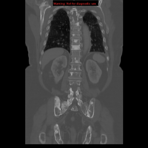 File:Breast cancer metastasis (Radiopaedia 10001-10554 B 48).jpg