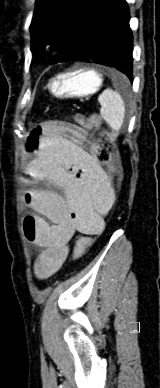 Broad ligament hernia (Radiopaedia 84802-100276 C 8).jpg