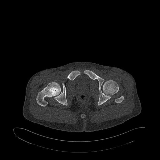 Brodie abscess- femoral neck (Radiopaedia 53862-59966 Axial bone window 164).jpg