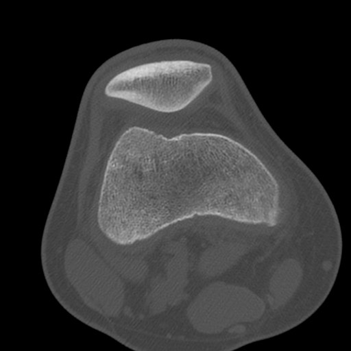 Brodie abscess of the tibia (Radiopaedia 58984-66250 Axial bone window 26).jpg