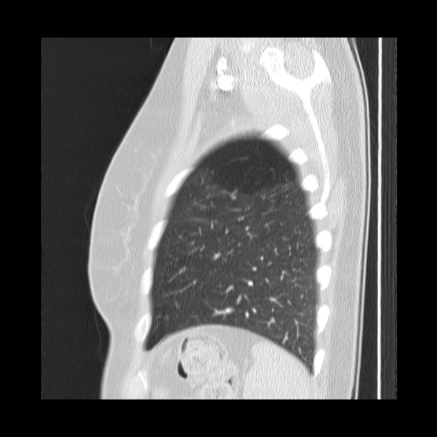 Bronchial atresia (Radiopaedia 22965-22992 Sagittal lung window 9).jpg