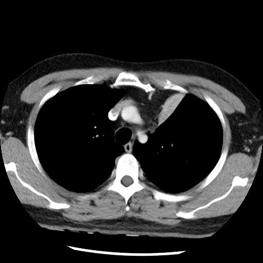 Bronchial carcinoid tumor (Radiopaedia 67377-76764 A 19).jpg