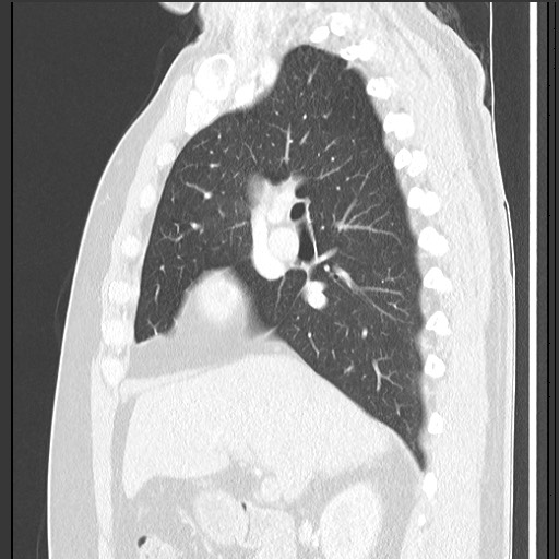 Bronchial carcinoid tumor (Radiopaedia 67377-76764 Sagittal lung window 28).jpg