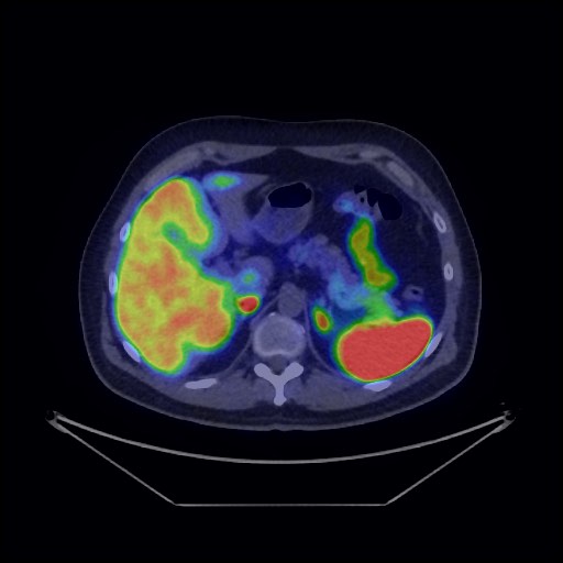 Bronchial carcinoid tumor (Radiopaedia 67377-76765 68Ga-DOTATATE PET-CT 43).jpg