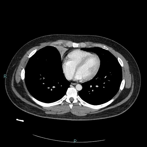 Bronchial carcinoid tumor (Radiopaedia 78272-90875 A 64).jpg