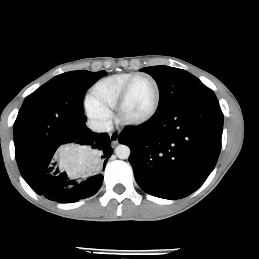 File:Bronchial carcinoid tumor causing right lower lobe collapse (Radiopaedia 83495-98594 A 38).jpg