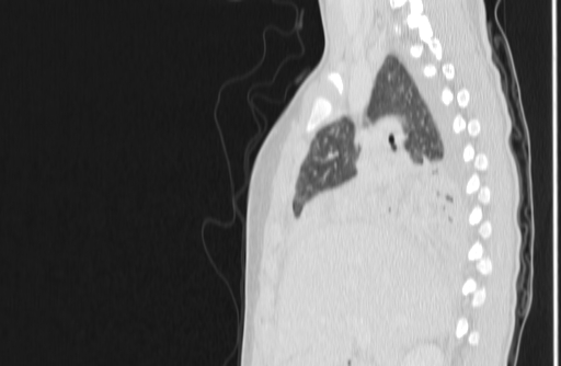 File:Bronchial mucoepidermoid carcinoma (Radiopaedia 57023-63895 Sagittal lung window 47).jpg