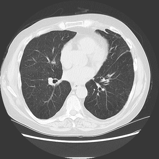 Bronchial stenosis - lung transplant (Radiopaedia 73133-83848 Axial lung window 37).jpg