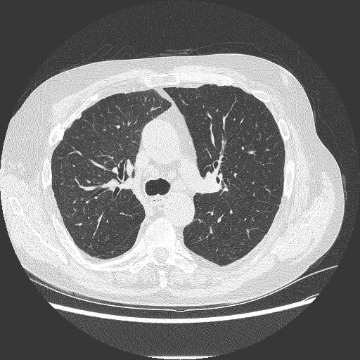File:Bronchial stenosis - lung transplant (Radiopaedia 73133-83848 B 13).jpg