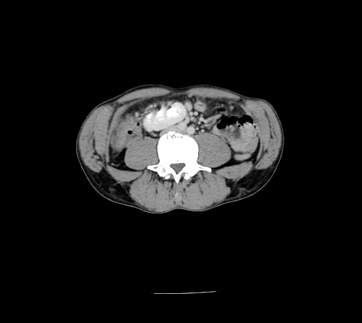 Bronchiectasis in Crohn disease (Radiopaedia 60311-67977 B 102).jpg