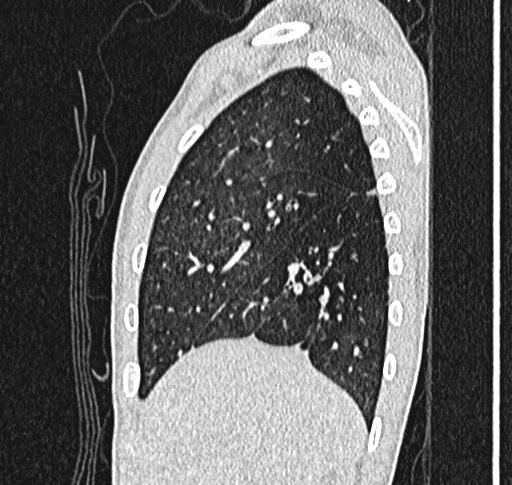 Bronchiolitis obliterans (Radiopaedia 71538-81897 Sagittal lung window 13).jpg