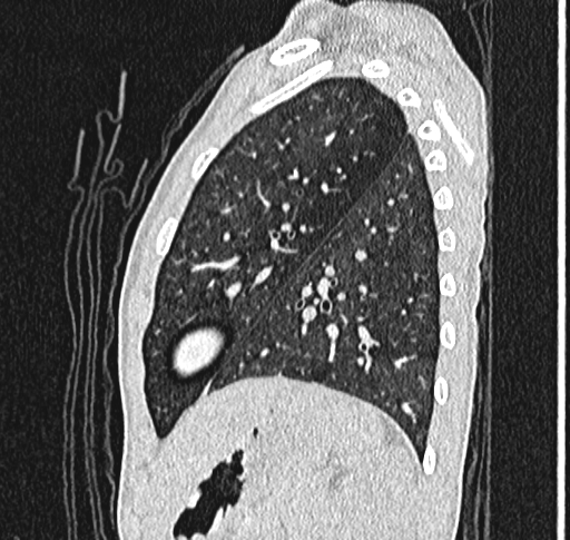 Bronchiolitis obliterans (Radiopaedia 71538-81897 Sagittal lung window 53).jpg